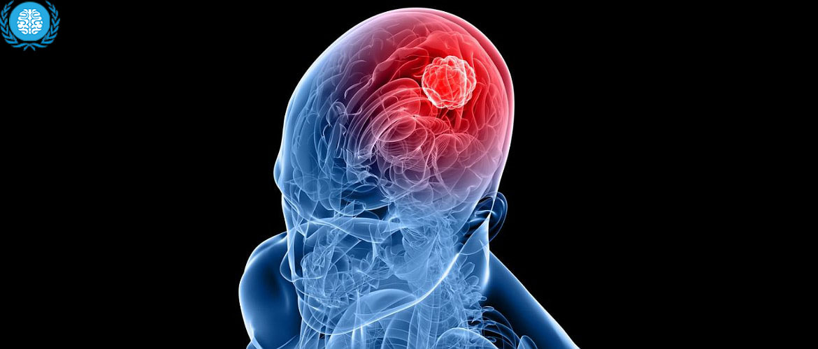 Опухоль головного мозга - это... Что такое Опухоль головного мозга?