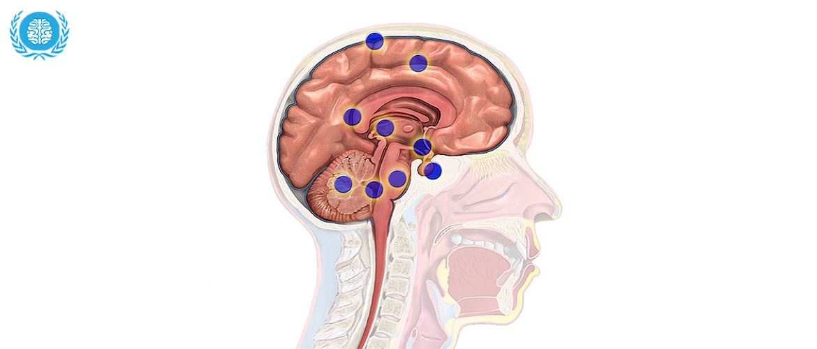 Специфика удаления опухоли головного мозга виды операций и реабилитационный период