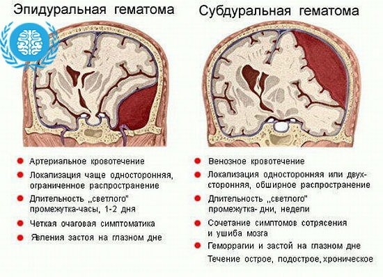 Гематомы головного мозга разновидности